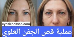 عملية قص الجفن العلوي – تجربتي المخاطر والأسعار